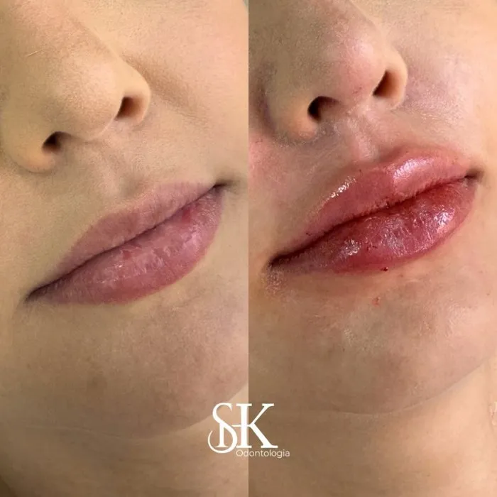 Resultados 2 SHK Odontologia