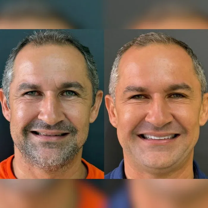 Resultados 3 SHK Odontologia